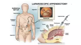 appendectomy uai