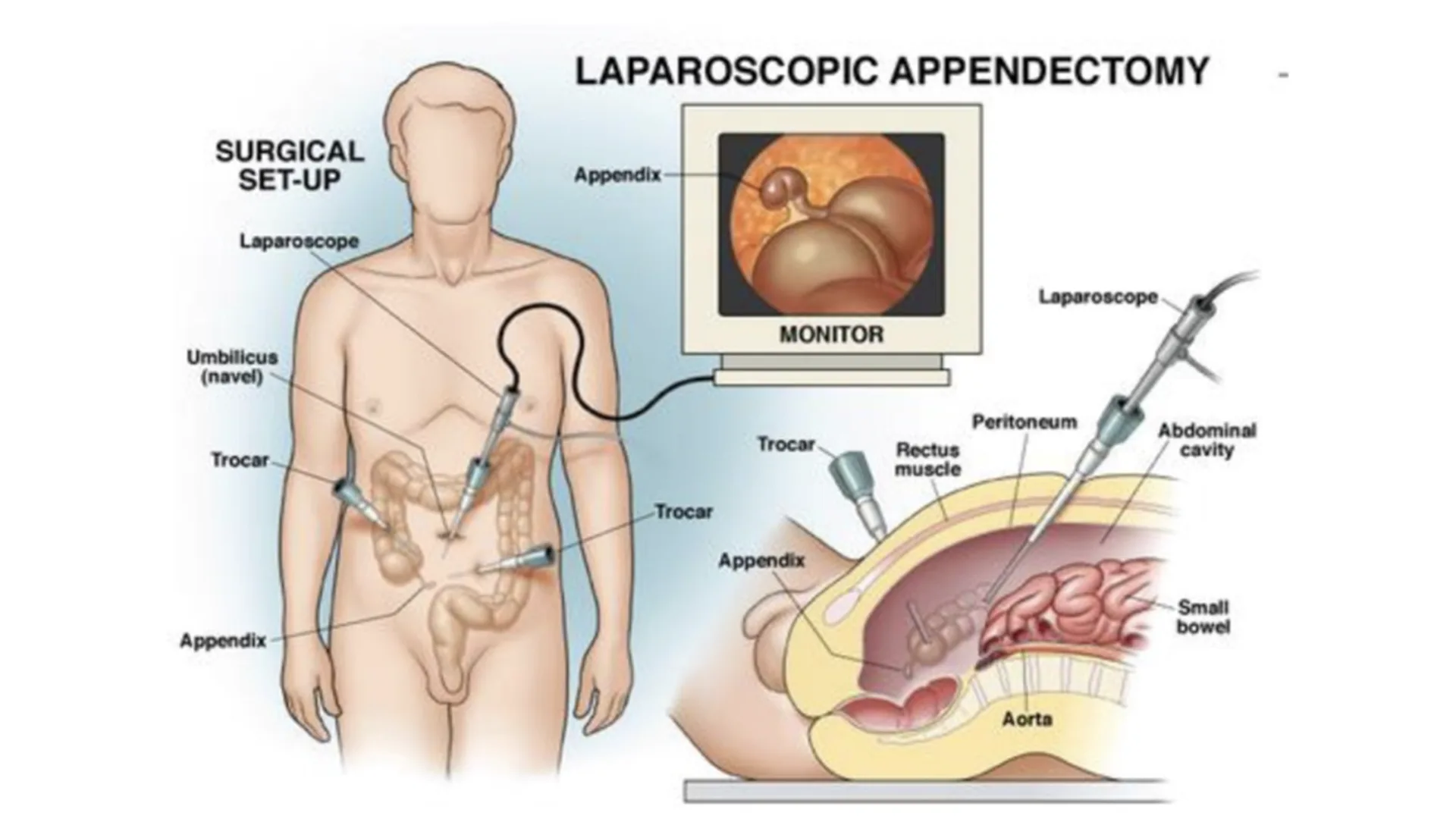 appendectomy