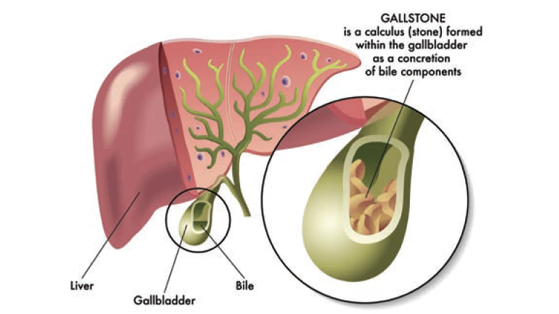 cholecystectomy