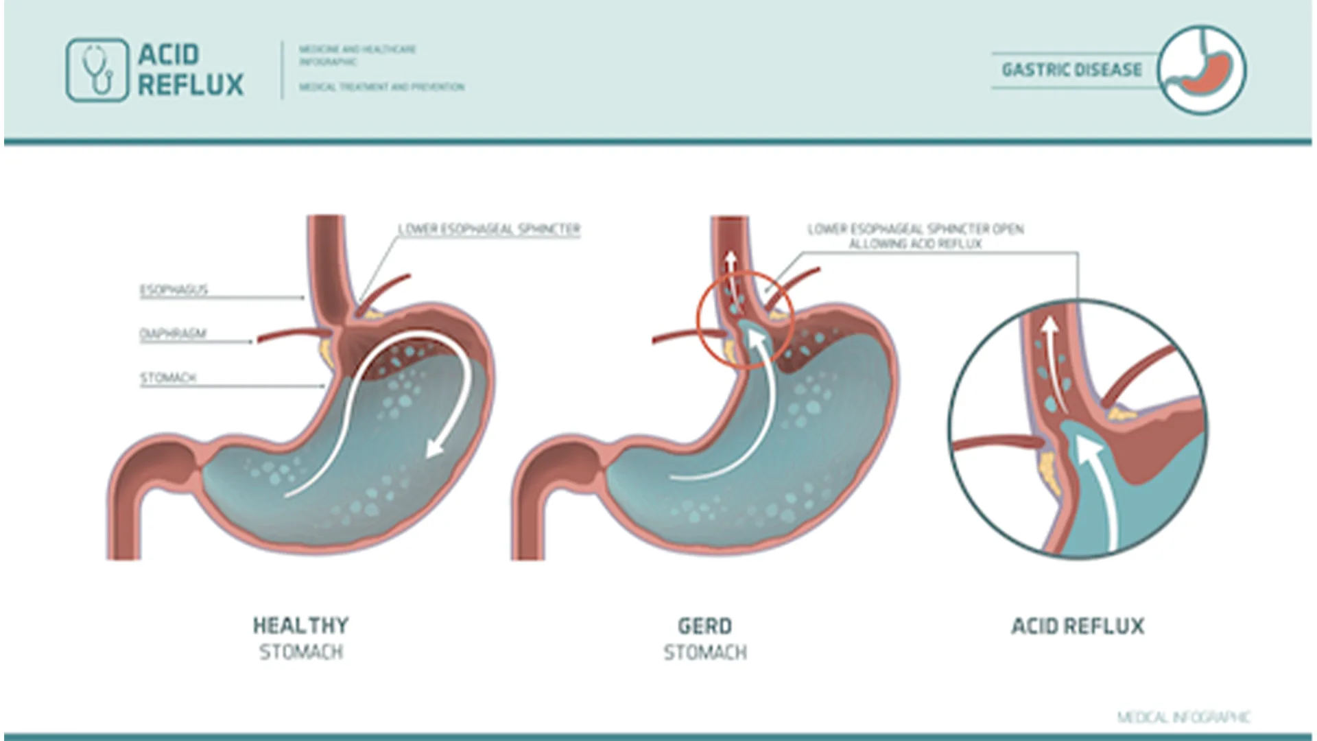 gastroesophageal reflux disease