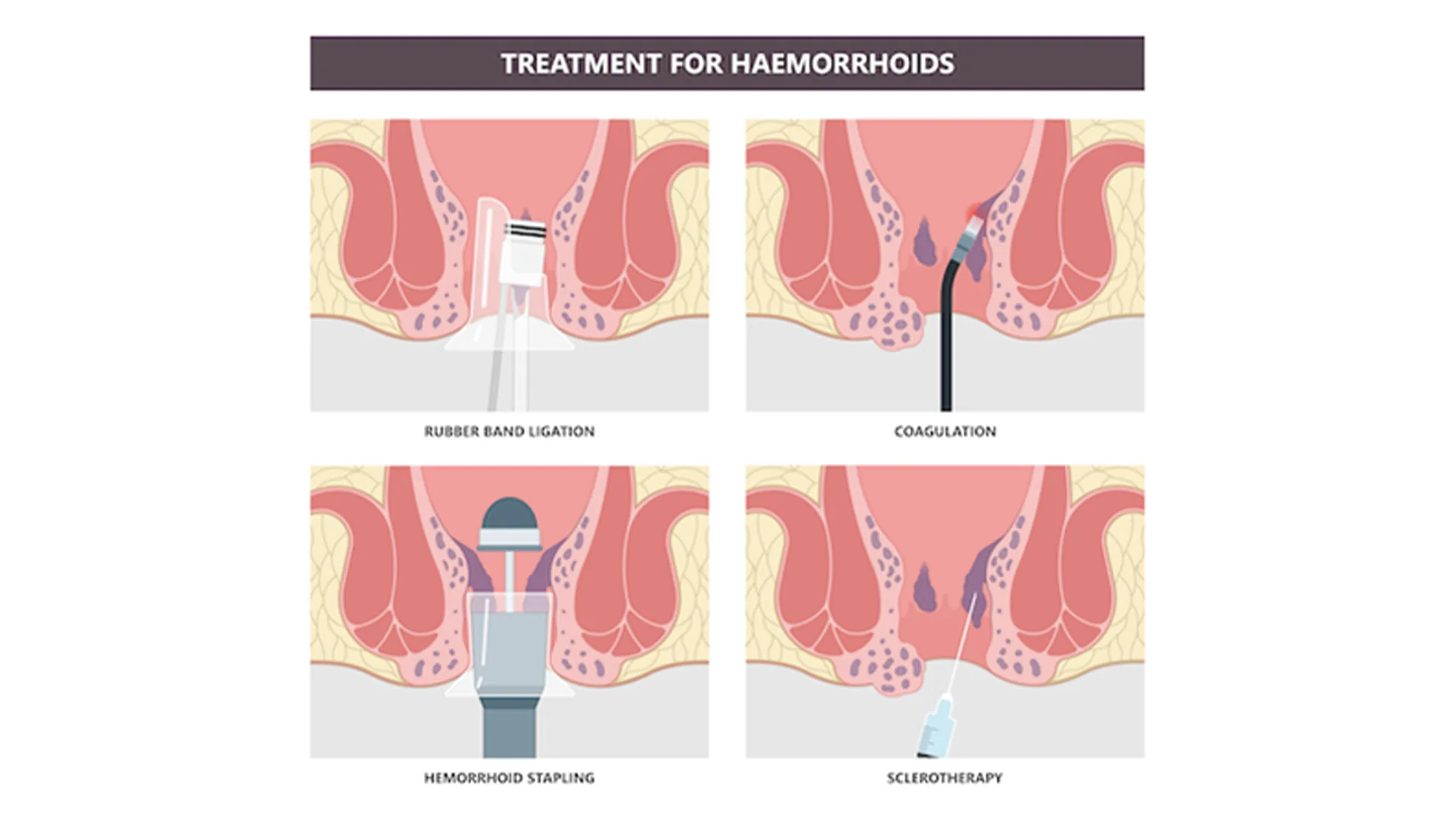 haemorrhoids