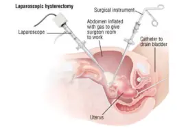 Laparoscopic Hysterectomy in Nairobi