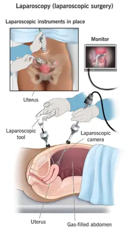 laparoscopic surgery